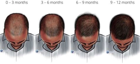 finasteride timeline|Iba pa.